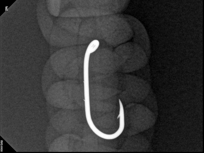 X-Ray of Fishing Hook in Braided Cord