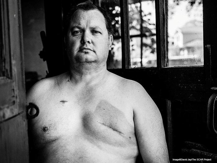 Bill Becker (Courtesy of David Jay The SCAR Project)