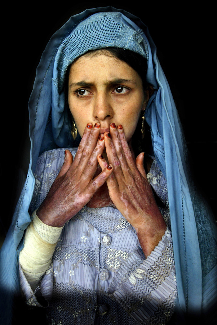 An Afghan woman with severe burns on 45% of her body from self-immolation shows her scars at a hospital in Herat.